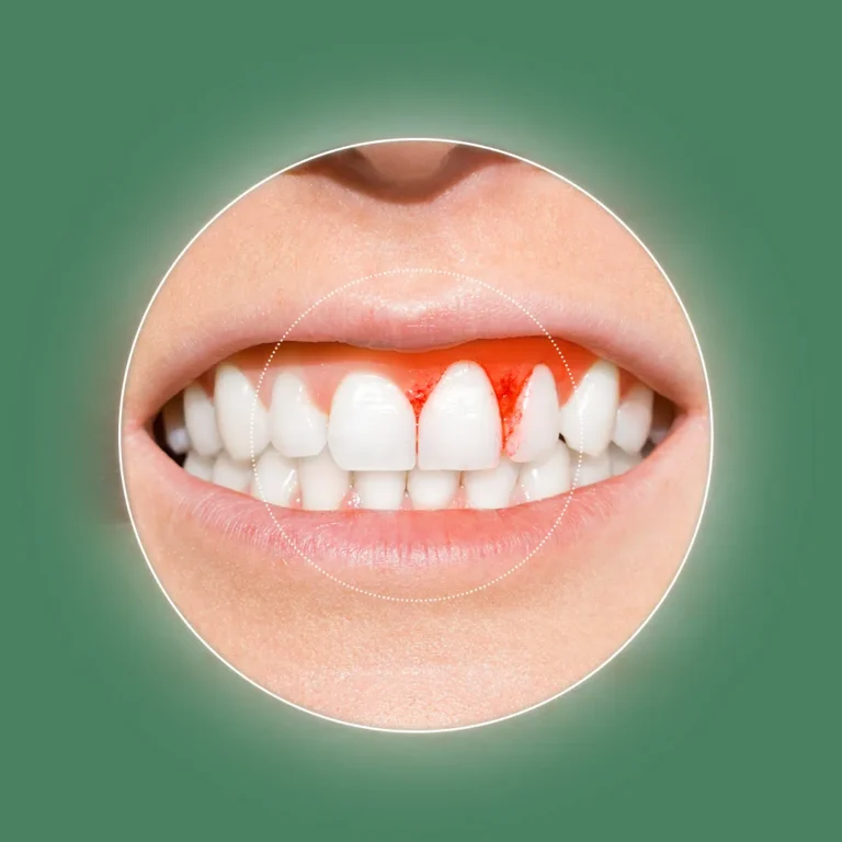 التهاب و عفونت لثه: از علائم اولیه تا پیشگیری روزانه